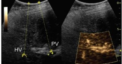 Ultrasound Imaging of Portal Hypertension Using Microbubbles image